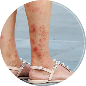 Mycobacterium fortuitum lesions